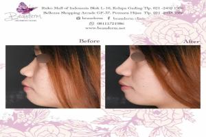 Filler Hidung / Nose Filler
